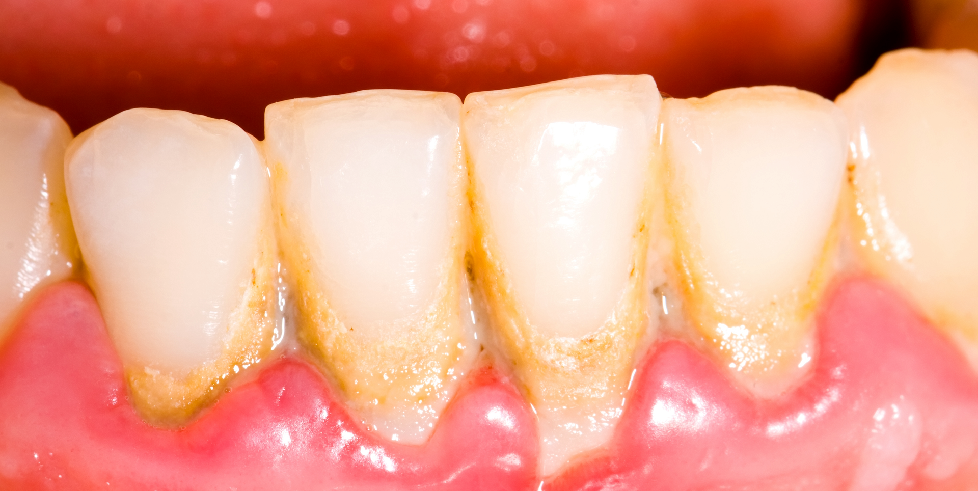 歯石・歯垢（プラーク） イメージ