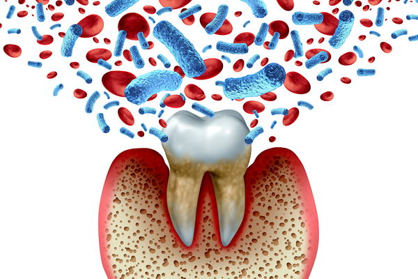 歯茎に細菌が入り込むイメージ